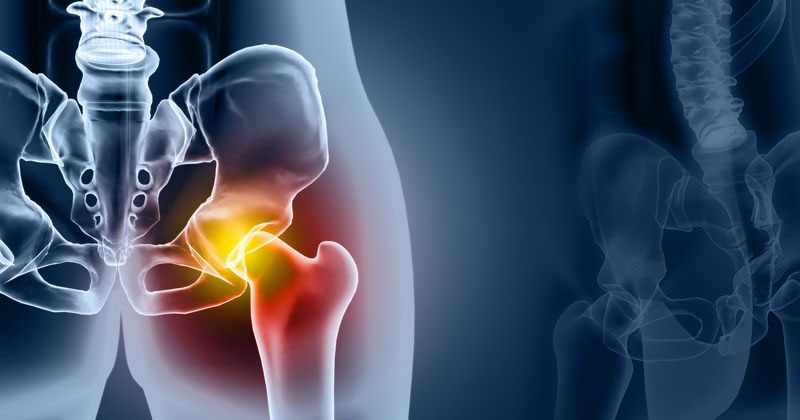 How arthroscopy helps young adults with borderline hip dysplasia: Study